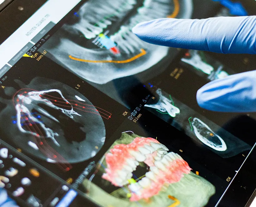 Dantų implantacija