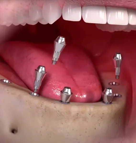 Visų dantų atkūrimas ant implantų