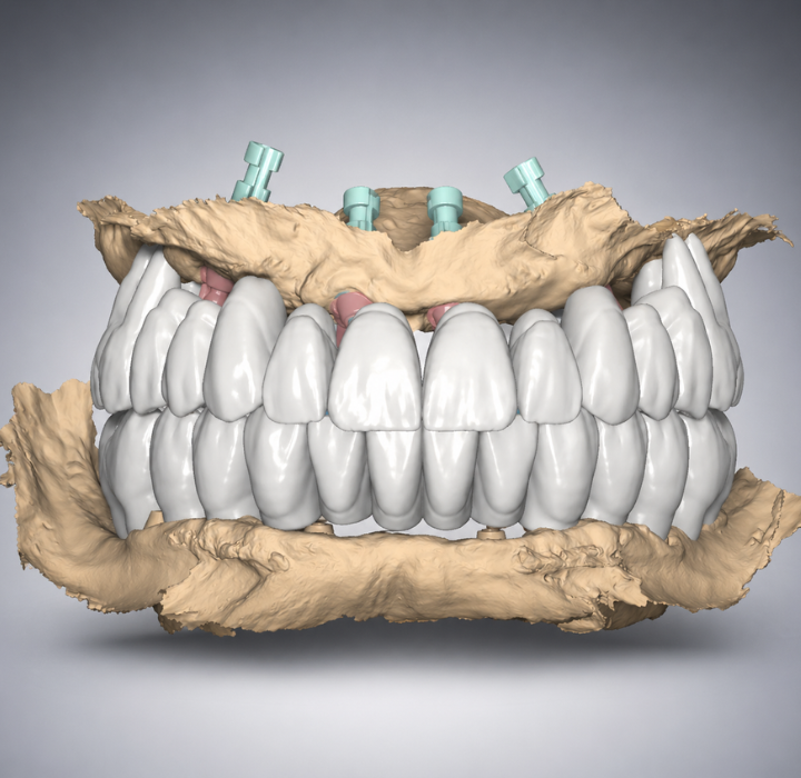 Implantacija be pjūvio. Gidinė implantacija