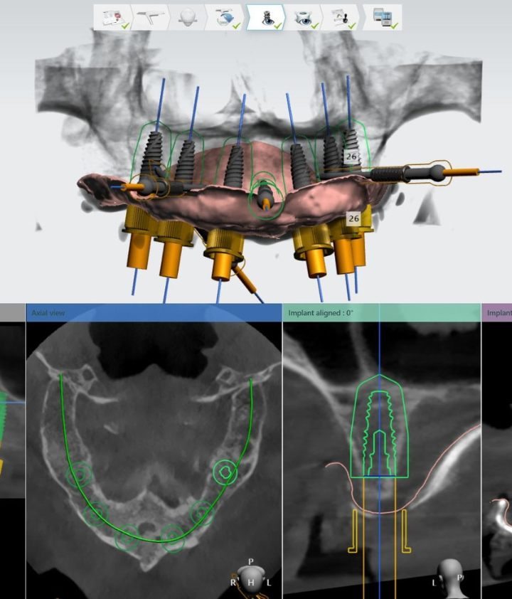 Vienmomentė implantacija