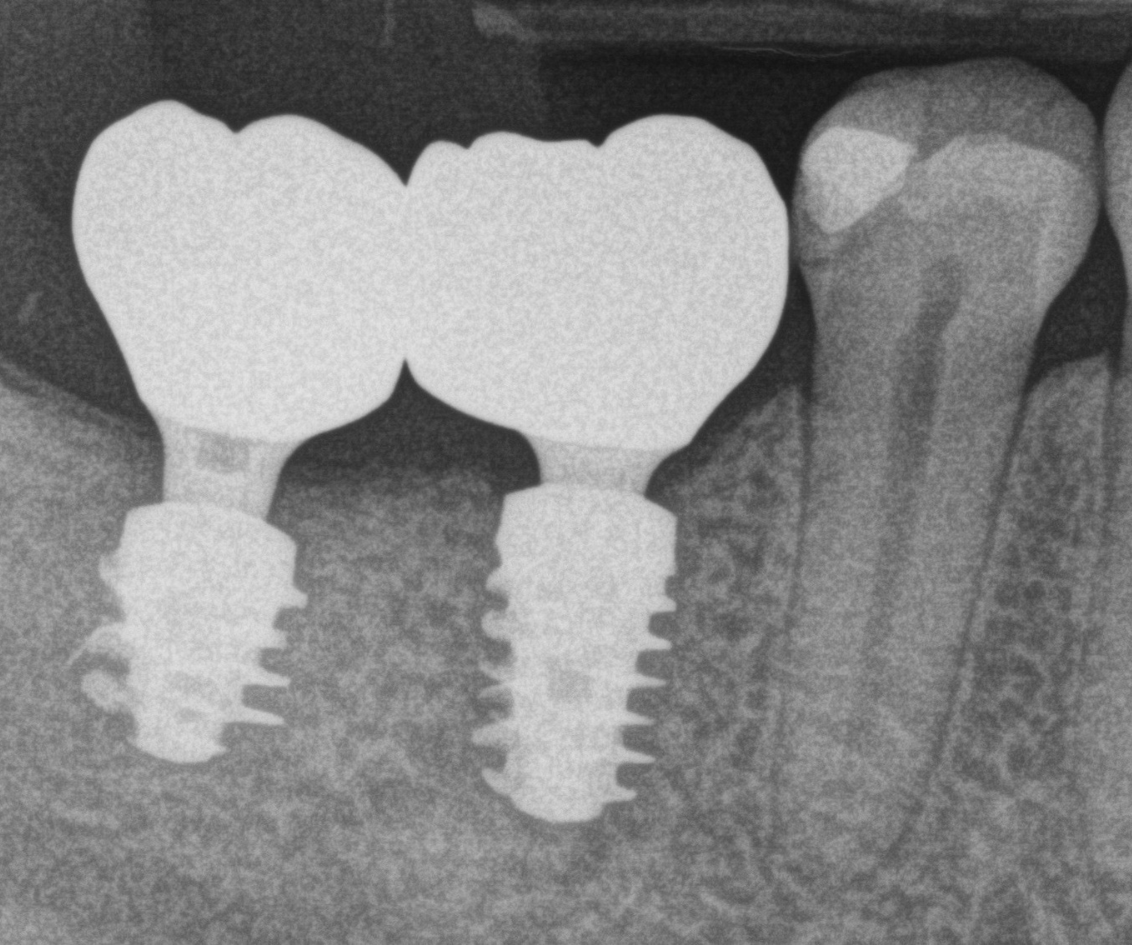 Vienmomentės implantacijos privalumai